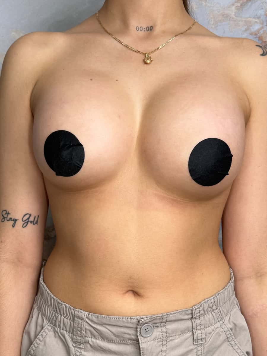 Breast augmentation before and after photo at Nip Tuck Aesthetics, showcasing natural results and expert cosmetic surgery.