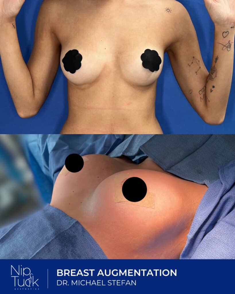 Natural-looking breast augmentation by Dr. Michael Stefan at Nip Tuck Aesthetics.