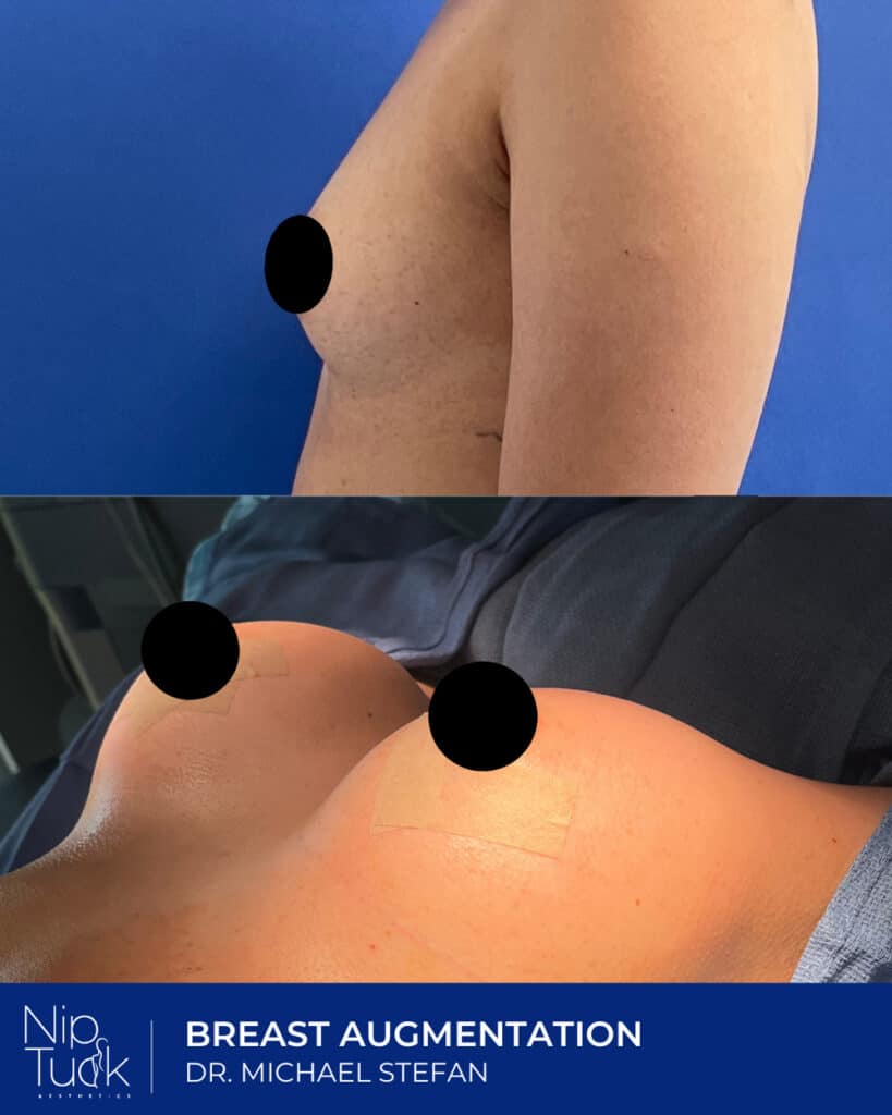 Breast augmentation before and after images at Nip Tuck Aesthetics, performed by Dr. Michael Stefan.