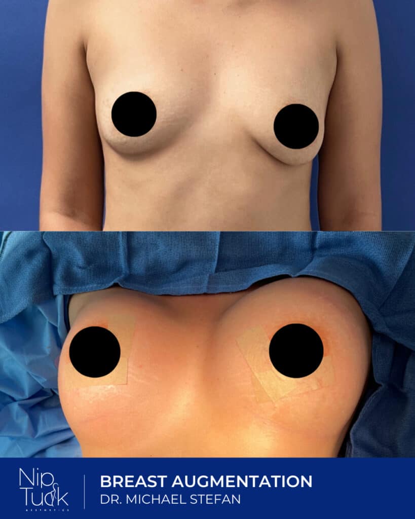 Enhanced breast augmentation before and after images at Nip Tuck Aesthetics.