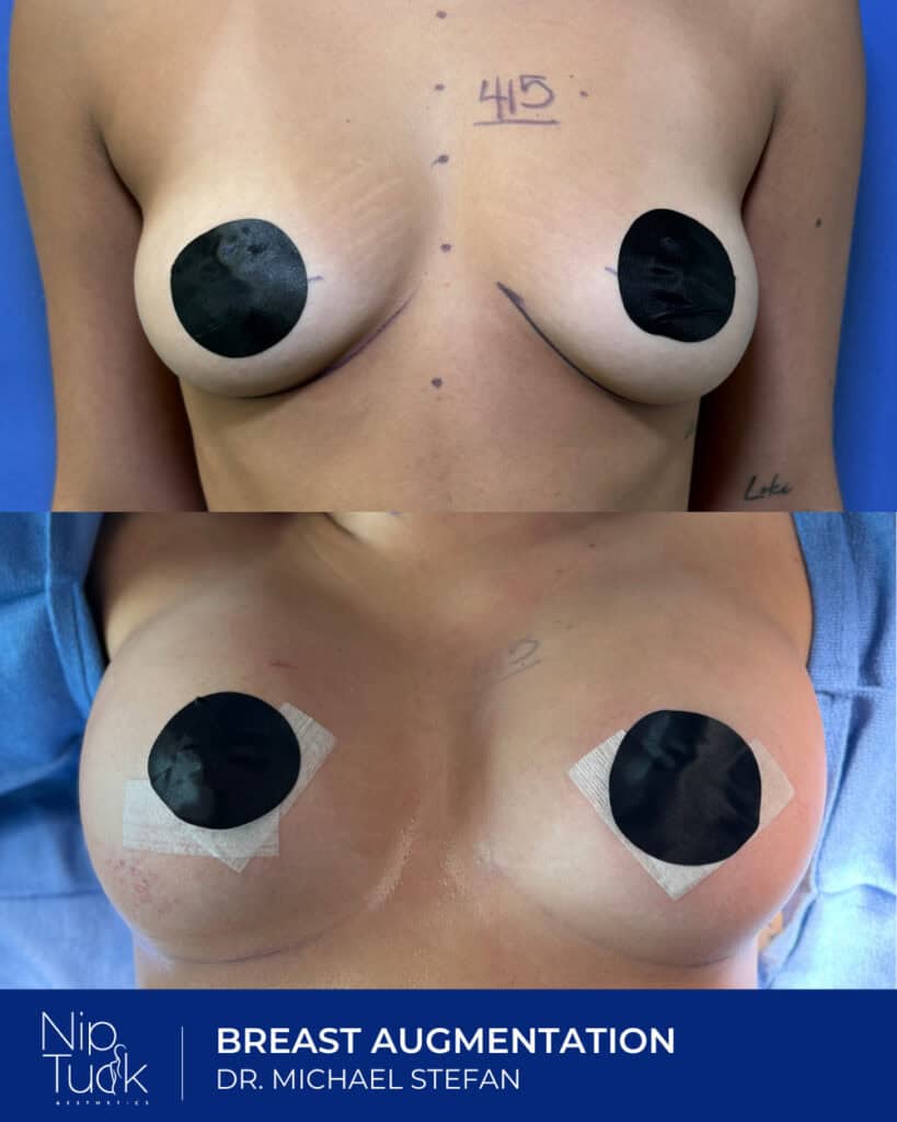 Natural breast augmentation after surgery by Dr. Michael Stefan at Nip Tuck Aesthetics.