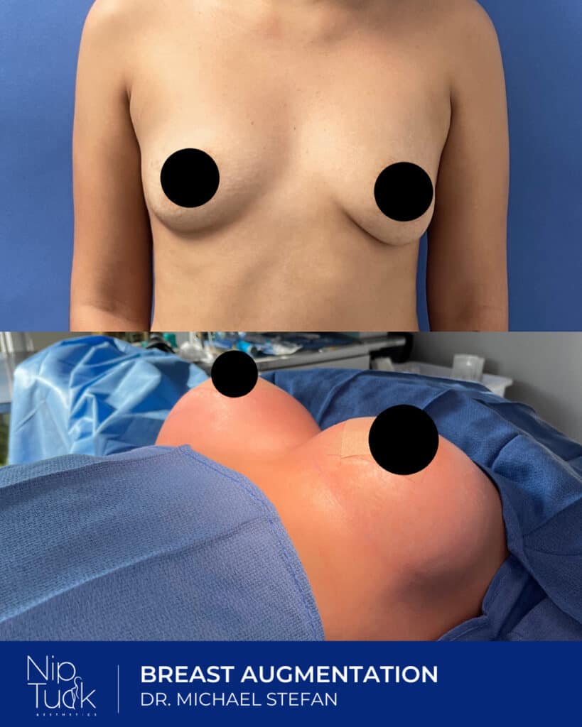 Breast augmentation before and after surgery with Dr. Michael Stefan at Nip Tuck Aesthetics.