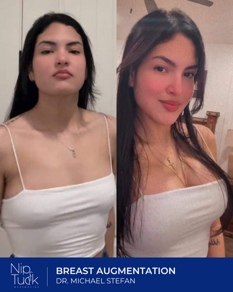 Enhanced breast augmentation results before and after by Dr. Michael Stefan at Nip Tuck Aesthetics.