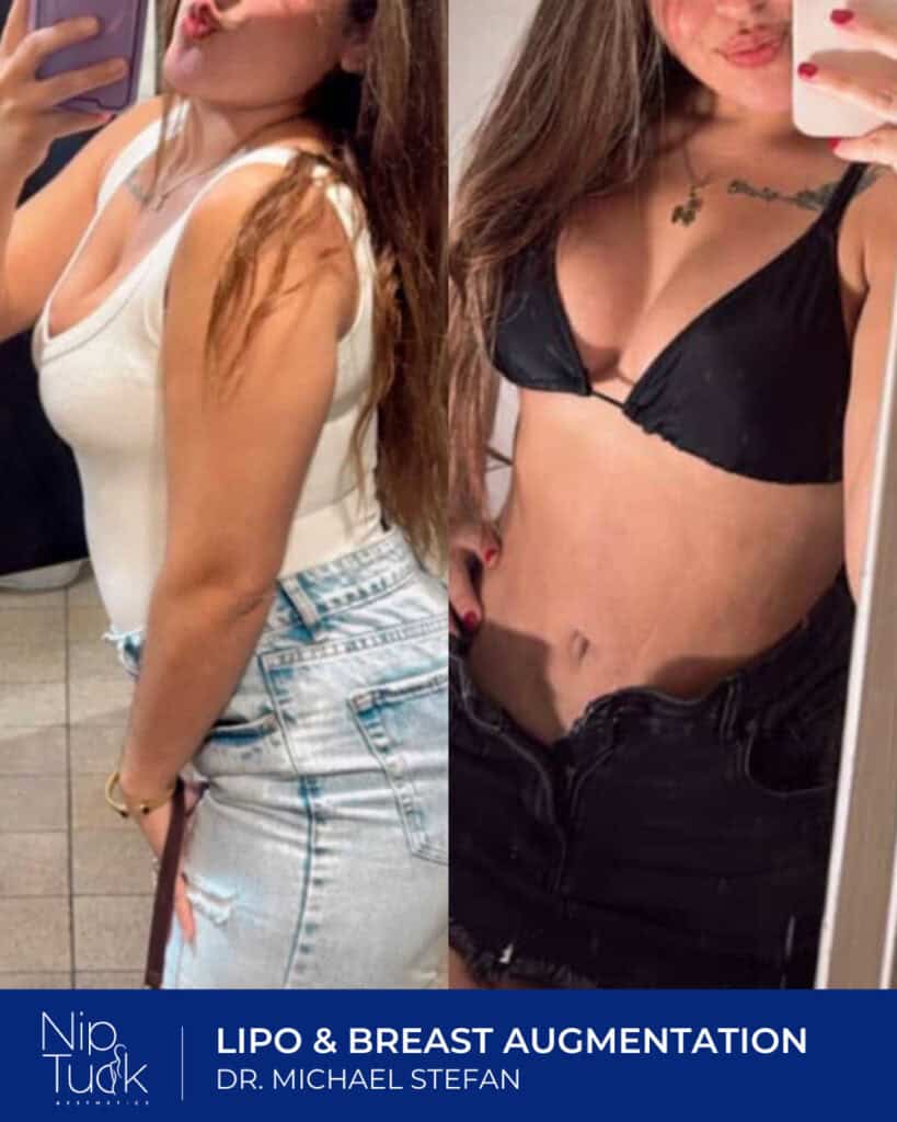 Liposuction and breast augmentation results, before and after photos from Nip Tuck Aesthetics.