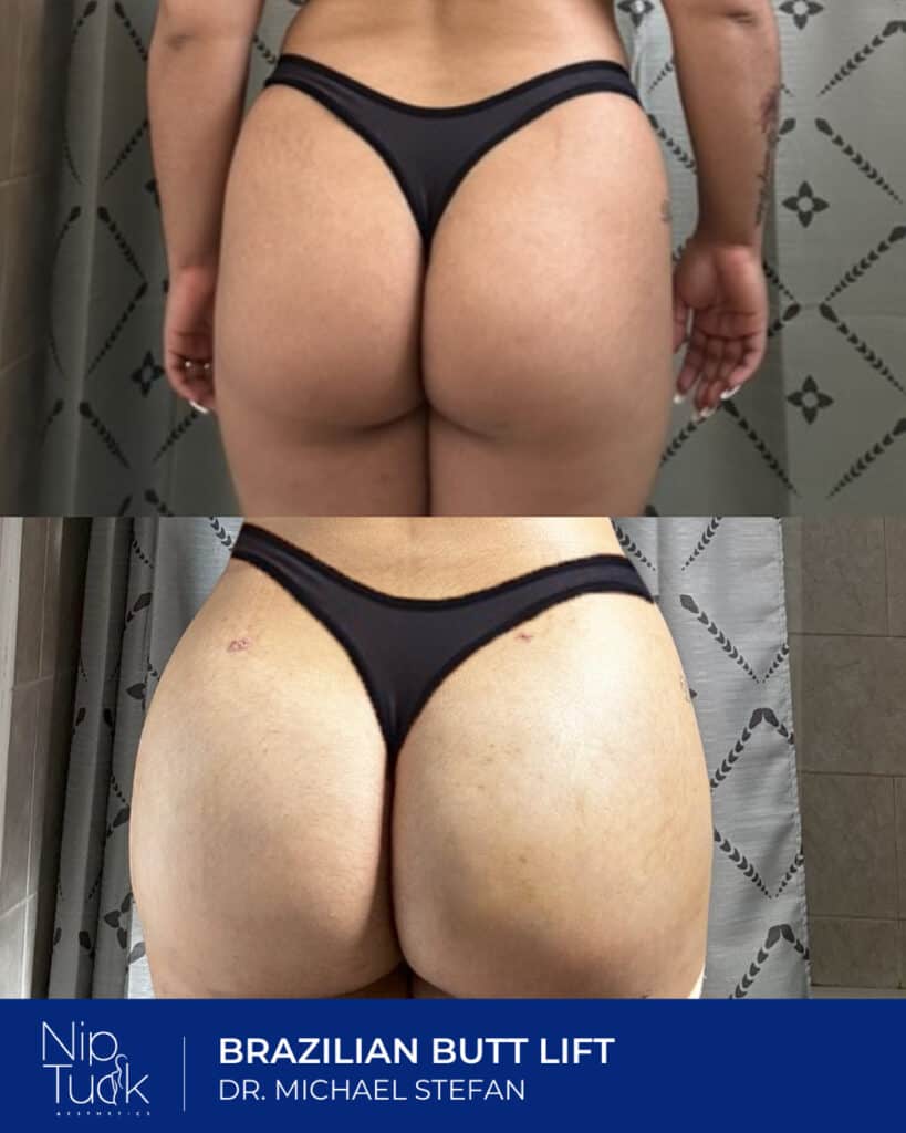 Smooth, natural-looking Brazilian butt lift results by Dr. Michael Stefan at Nip Tuck Aesthetics.