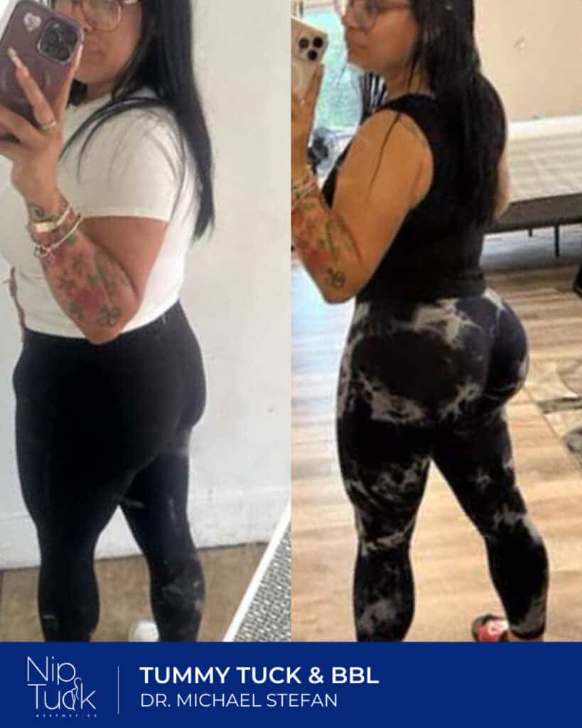 Slimming transformation of woman after Tummy Tuck & BBL at Nip Tuck Aesthetics.