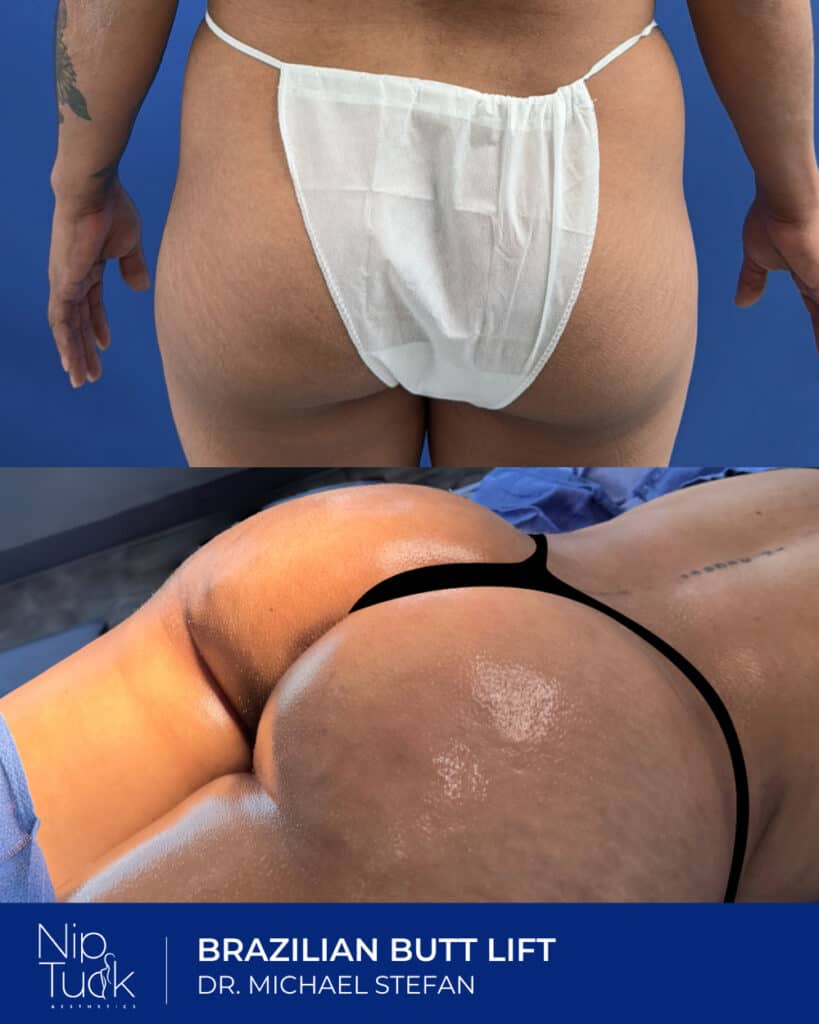 Natural Brazilian butt lift before and after aesthetic procedure at Nip Tuck Aesthetics.