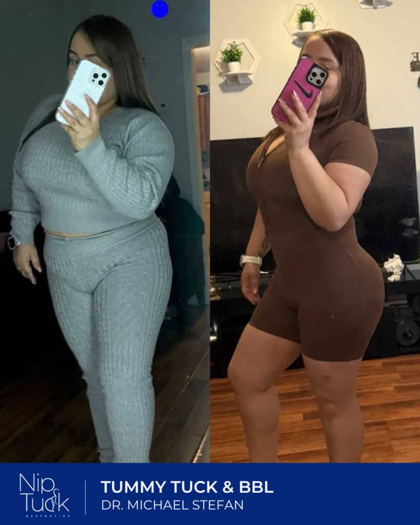 Slimming transformation after tummy tuck and BBL by Dr. Michael Stefan at Nip Tuck Aesthetics.
