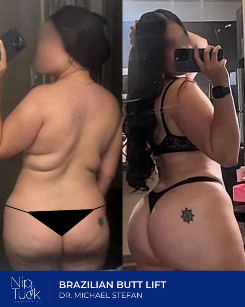 Brazilian butt lift transformation by Dr. Michael Stefan at Nip Tuck Aesthetics. Achieve a natural, shapely, and enhanced buttock contour.