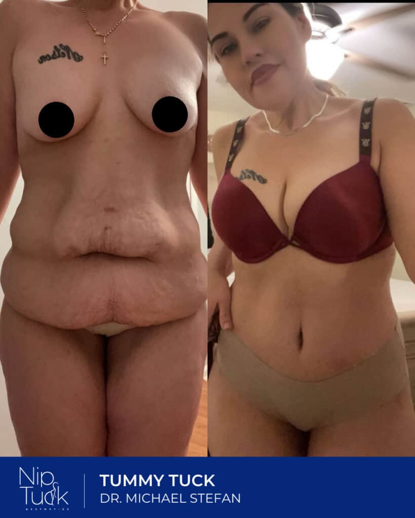 Folded abdomen before and after tummy tuck, Nip Tuck Aesthetics, Dr. Michael Stefan surgical transformation, advanced body contouring results.