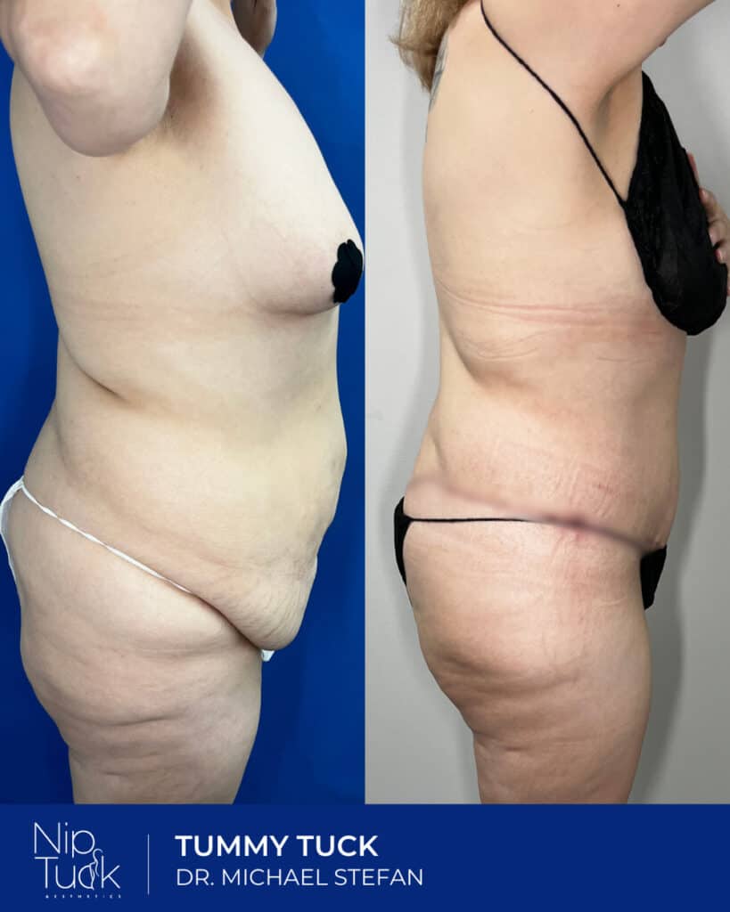 Abdominal fat reduction after Tummy Tuck surgery by Dr. Michael Stefan.