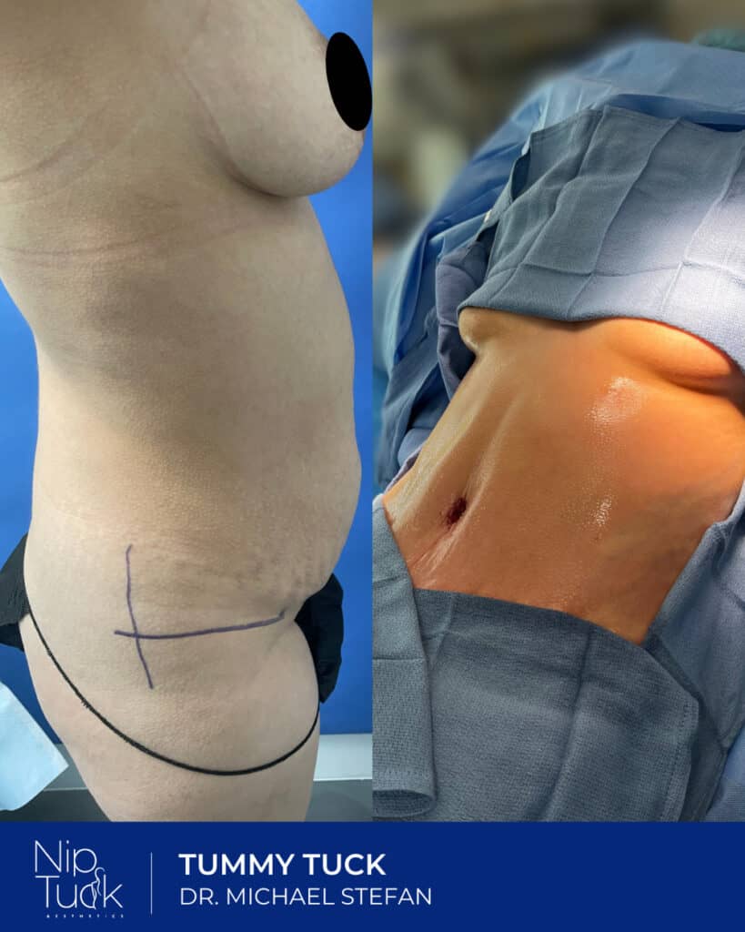 Reduced stomach after tummy tuck surgery by Dr. Michael Stefan at Nip Tuck Aesthetics.