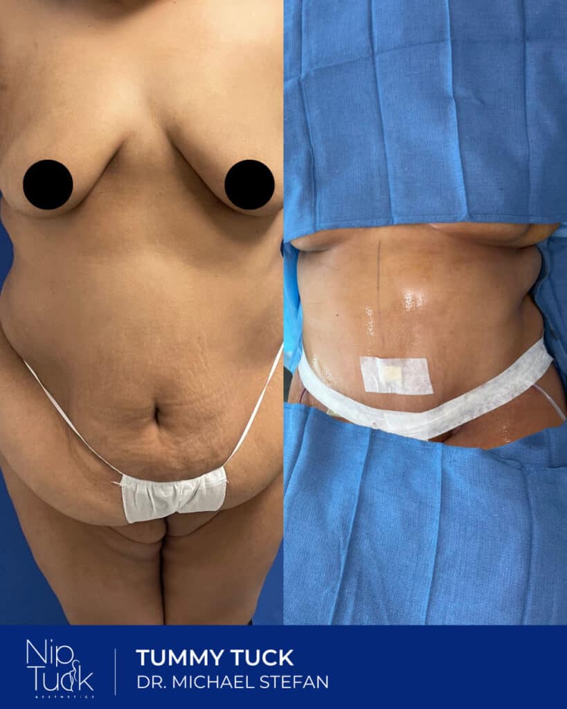 Scar reduction tummy tuck before and after by Dr. Michael Stefan at Nip Tuck Aesthetics.