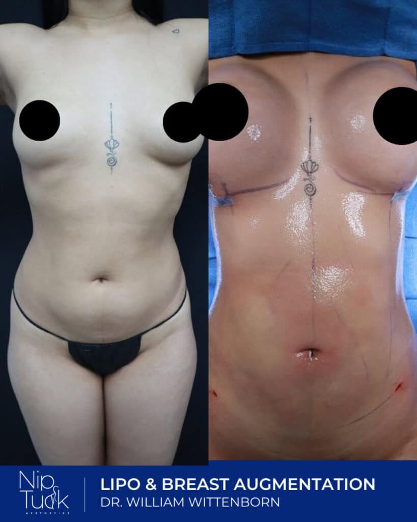 Slimming and breast augmentation before and after with Liposuction and breast enhancement by Dr. William Wittenborn.