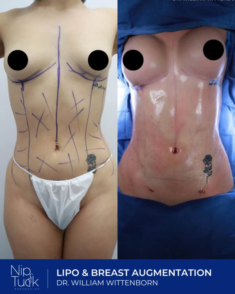Slim torso with markings for Lipo and breast augmentation surgery at Nip Tuck Aesthetics.