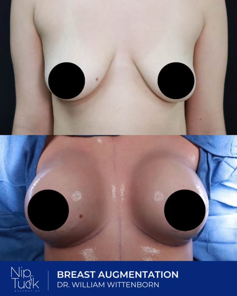 Breast augmentation before and after photos at Nip Tuck Aesthetics, performed by Dr. William Wittenborn.