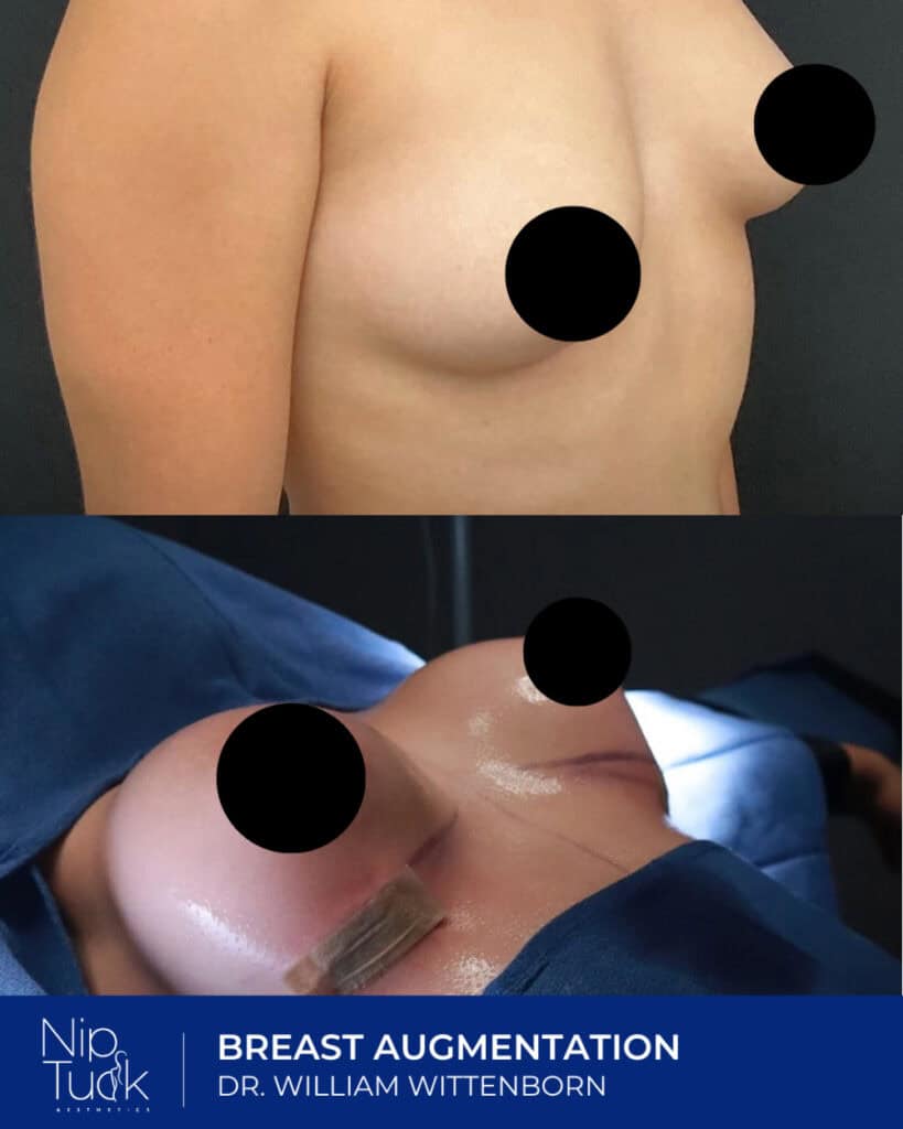 Enhanced natural breast augmentation by Dr. William Wittenborn at Nip Tuck Aesthetics.