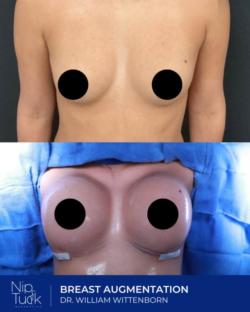 Enhanced natural-looking breast augmentation results at Nip Tuck Aesthetics.