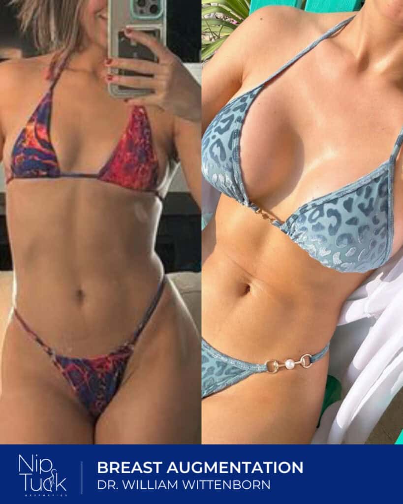 Breast augmentation before and after photos showcasing enhanced bust size with Dr. William Wittenborn.