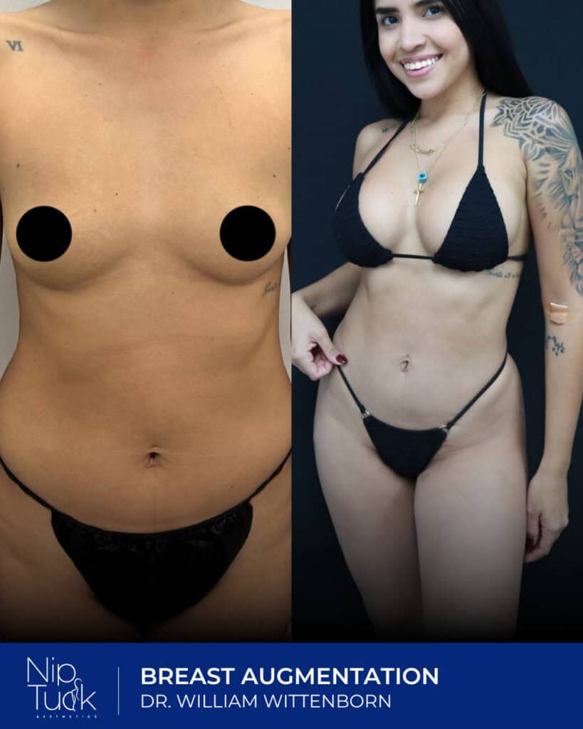Natural breast augmentation before and after results with Dr. William Wittenborn. Enhanced shape and size, confident and beautiful.