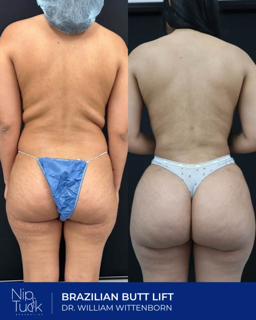 Slimming and contouring Brazilian Butt Lift before and after results at Nip Tuck Aesthetics.