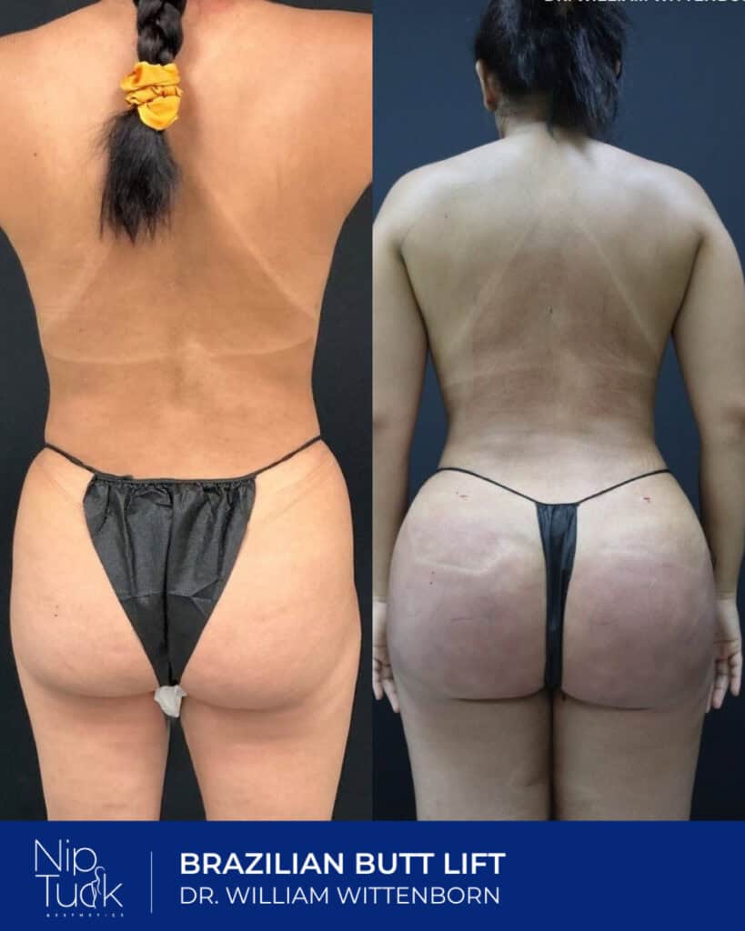 Slimming before and after Brazilian butt lift procedure by Dr. William Wittenborn at Nip Tuck Aesthetics.