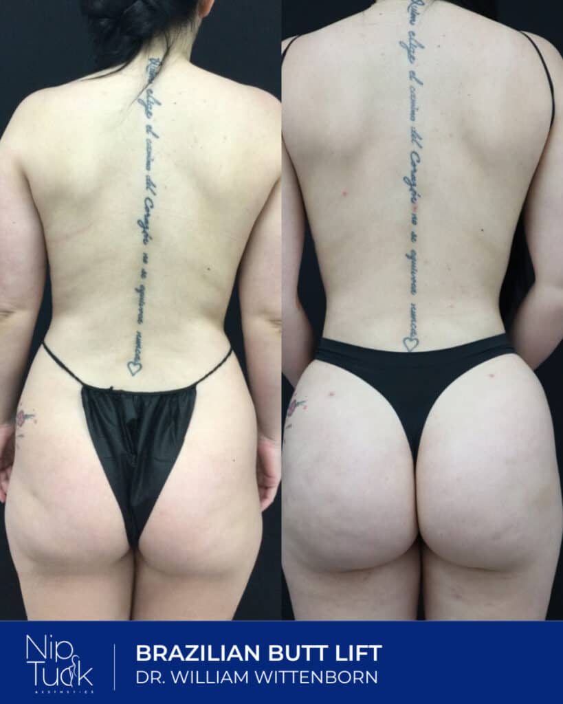 Smooth back and waist contour after Brazilian Butt Lift by Dr. William Wittenborn at Nip Tuck Aesthetics.