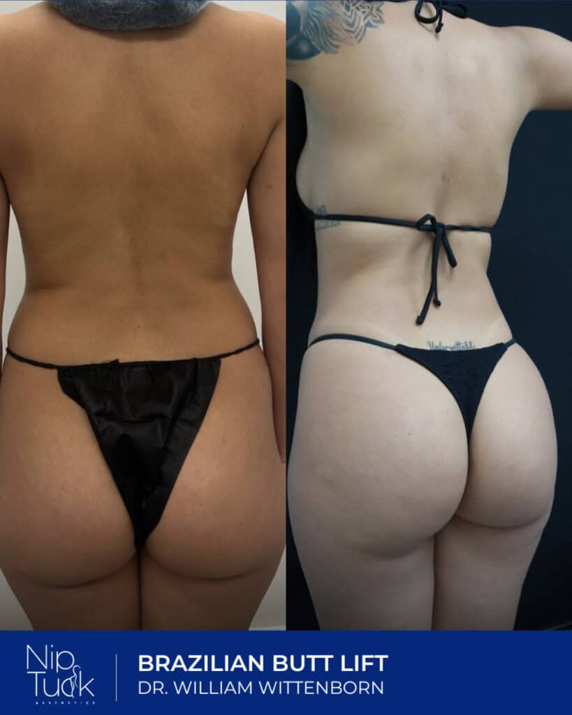 Slimmer waistline and lifted buttocks after Brazilian butt lift procedure.