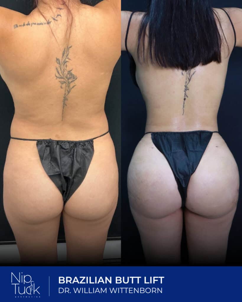 Slimming and lifting before and after images of Brazilian Butt Lift procedure by Dr. William Wittenborn at Nip Tuck Aesthetics.
