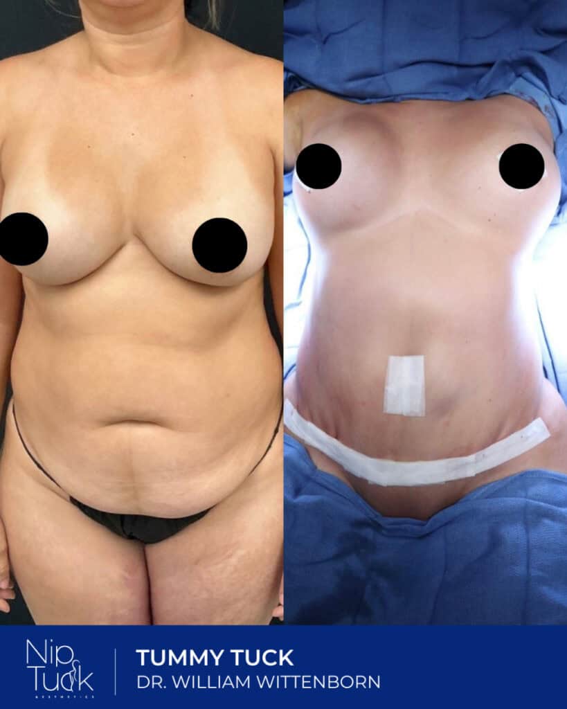 Liposuction tummy tuck before and after results, Dr. William Wittenborn, Nip Tuck Aesthetics.