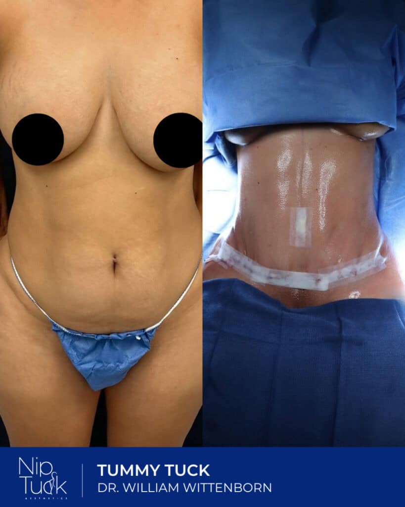 Healthy, toned abdomen after tummy tuck at Nip Tuck Aesthetics, performed by Dr. William Wittenborn.